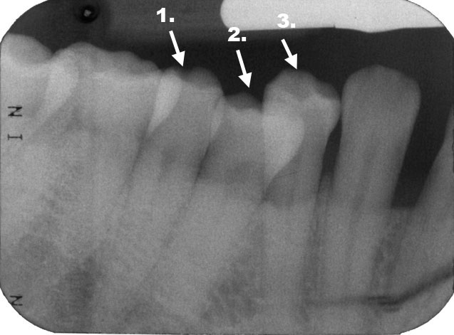 Minita Nyemah _2010130 Supernumerary premolar Arrows.jpg